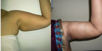 Arm Lifting Surgery