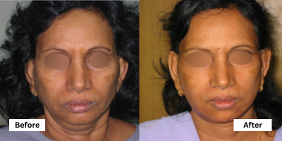 Face And Neck Lift Surgery