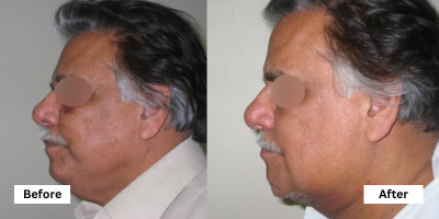 Face Lift Surgery Before and After