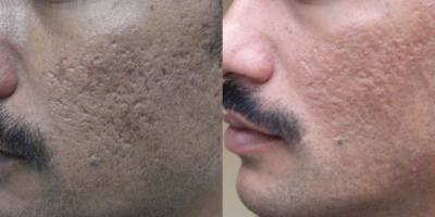 Acne Scars Surgery