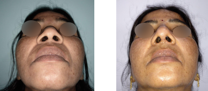 Rhinoplasty Surgery Procedure