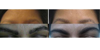 Eye Brow Hair Transplant Procedure