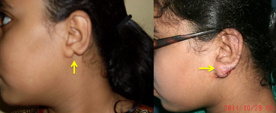 Ear Lobe Surgery Procedure