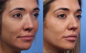 Lip Augmentation Surgery