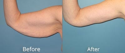 Brachioplasty Before and After