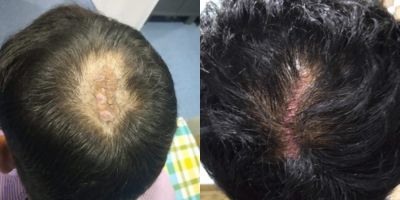 Scalp Nevus Removal Procedure