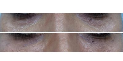 Under Eye Fat Transfer Procedure