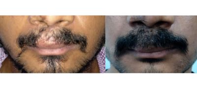 HT Moustache Transplant