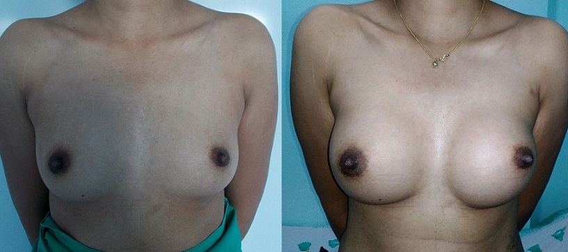 Breast Surgery procedure