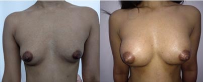 Breast Surgery