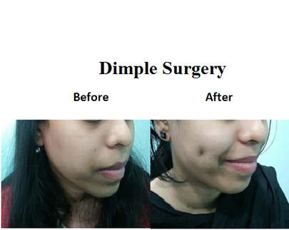 Dimple Creation Procedure