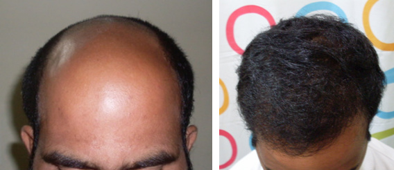 Hair Transplantation Surgery