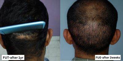 FUT Hair Line and Back Area Procedure