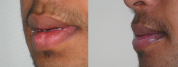 Lip Reduction Surgery