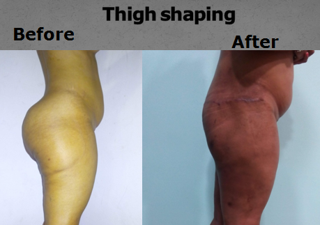 Thigh Shaping procedure
