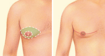 correction-of-enlarged-breast-in-male