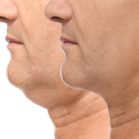 Double Chin Removal<br><br>