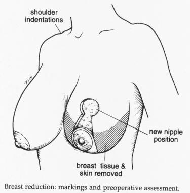 Suspended By Tits