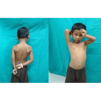 Erb's Palsy<br><br>