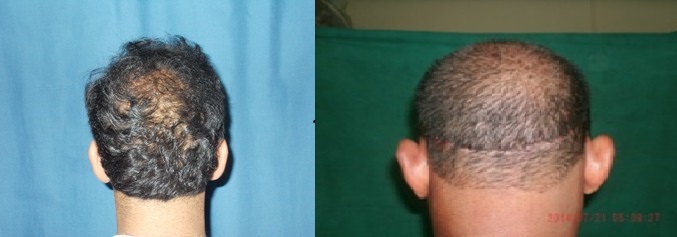 hair-transplant-trichophytic-closure-treatment-in-hyderabad