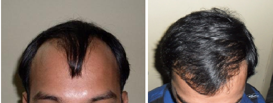 follicular-unit-transplantation-or-strip-method-hair-transplant