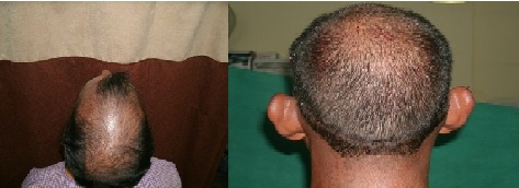 latest-follicular-unit-extraction-treatment-in-hyderabad
