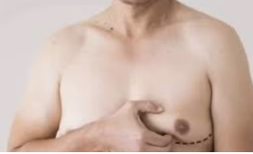 Nose Surgery Procedure