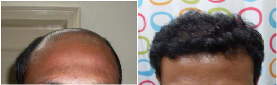 permanent-solution-for-hair-loss-in-hyderabad