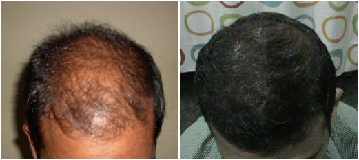 hair-line-design-and-graft-site-creation