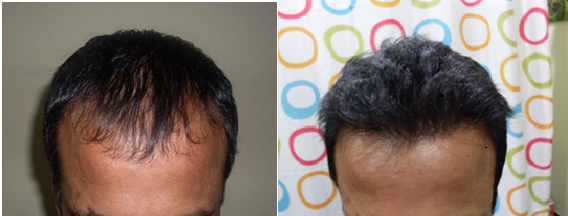 low-density-hair-treatment-in-hyderabad