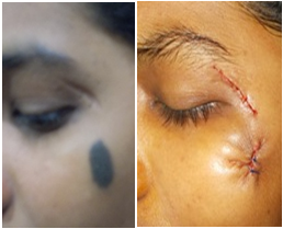 best-scars-treatment-and-plastic-surgery-in-hyderabad