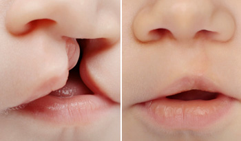 cleft-lip-and-palate-treatment-in-hyderabad