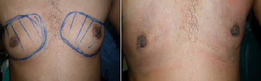 Best Lipoma And Skin Lumps Surgery In Hyderabad