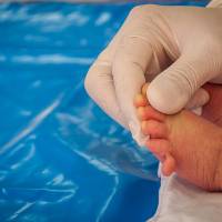 Polydactyly Surgery in Hyderabad