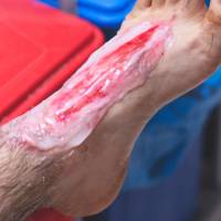 Burn Treatment in Hyderabad