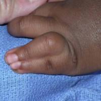 Painful Finger joints in Hyderabad