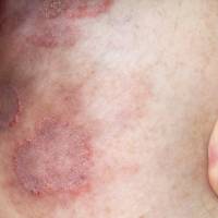 Ringworm in Hyderabad
