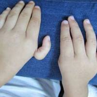 Hypoplastic Thumb <br><br>