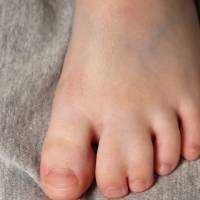 Syndactyly in Hyderabad
