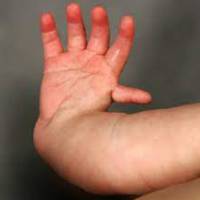 Radial Club Hand<br><br>