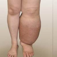Lymphedema Treatment in Hyderabad