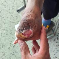 Diabetic Foot ulcer<br><br>