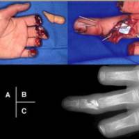 Microsurgery<br><br>