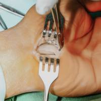 Wrist Surgery<br><br>