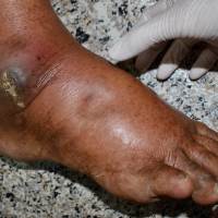 Limb Lengthening Surgery in Hyderabad