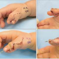 Thumb Surgery in Hyderabad