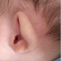 Ear Surgery<br><br>