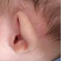 Ear Surgery in Hyderabad