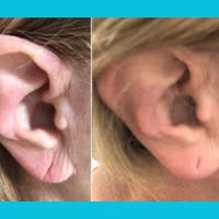 Earlobe Repair in Hyderabad