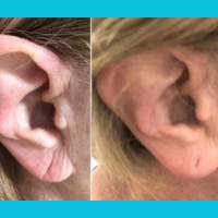 Earlobe Repair<br><br>